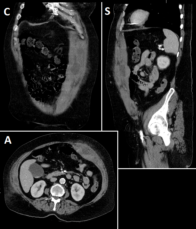 Abdomen CT — Axial View