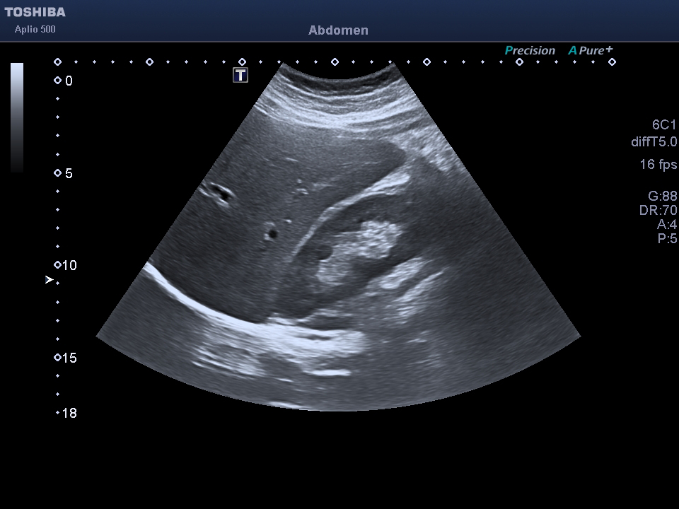 Abdomen Ultrasound — Liver