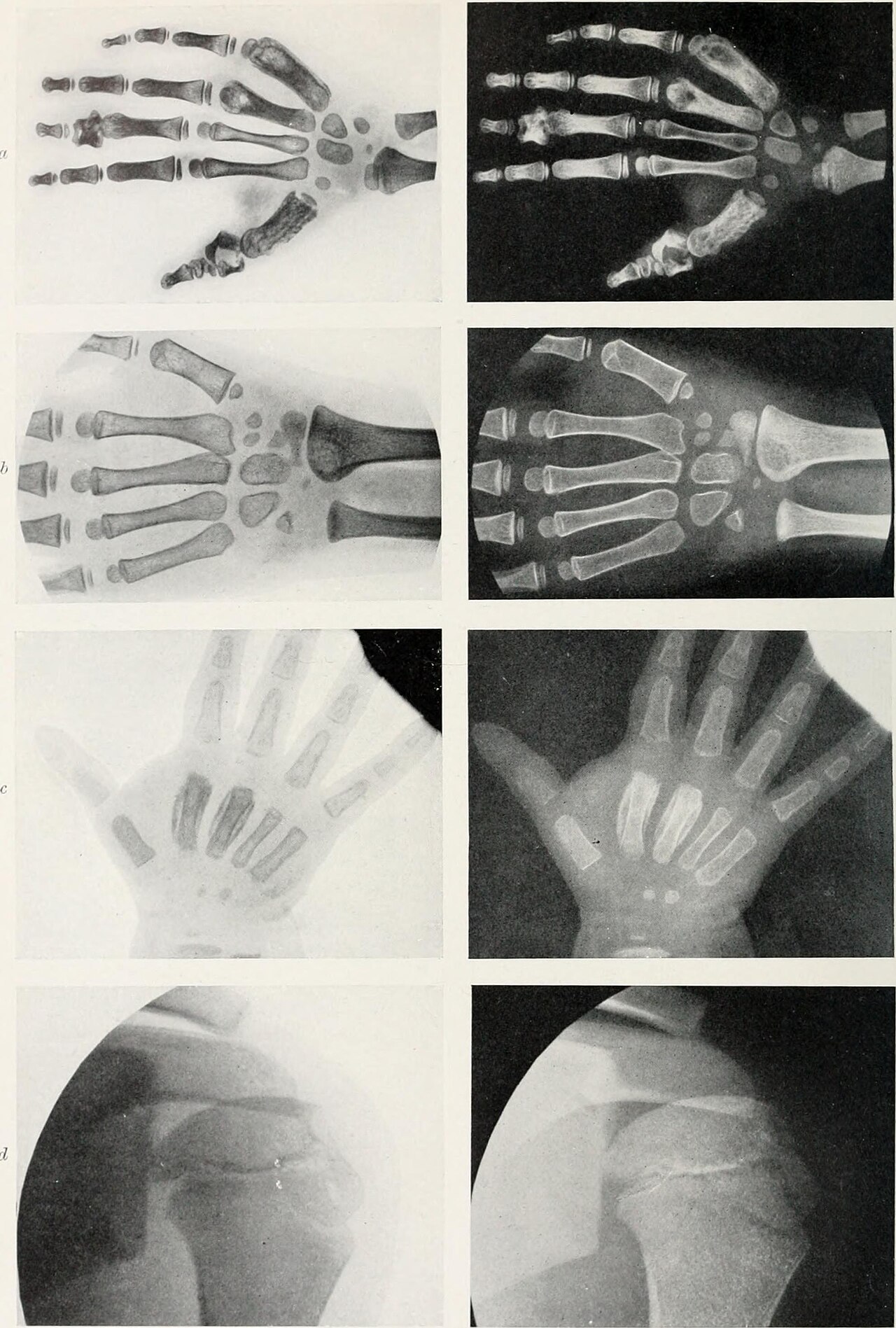 Ankle X-ray — Lateral