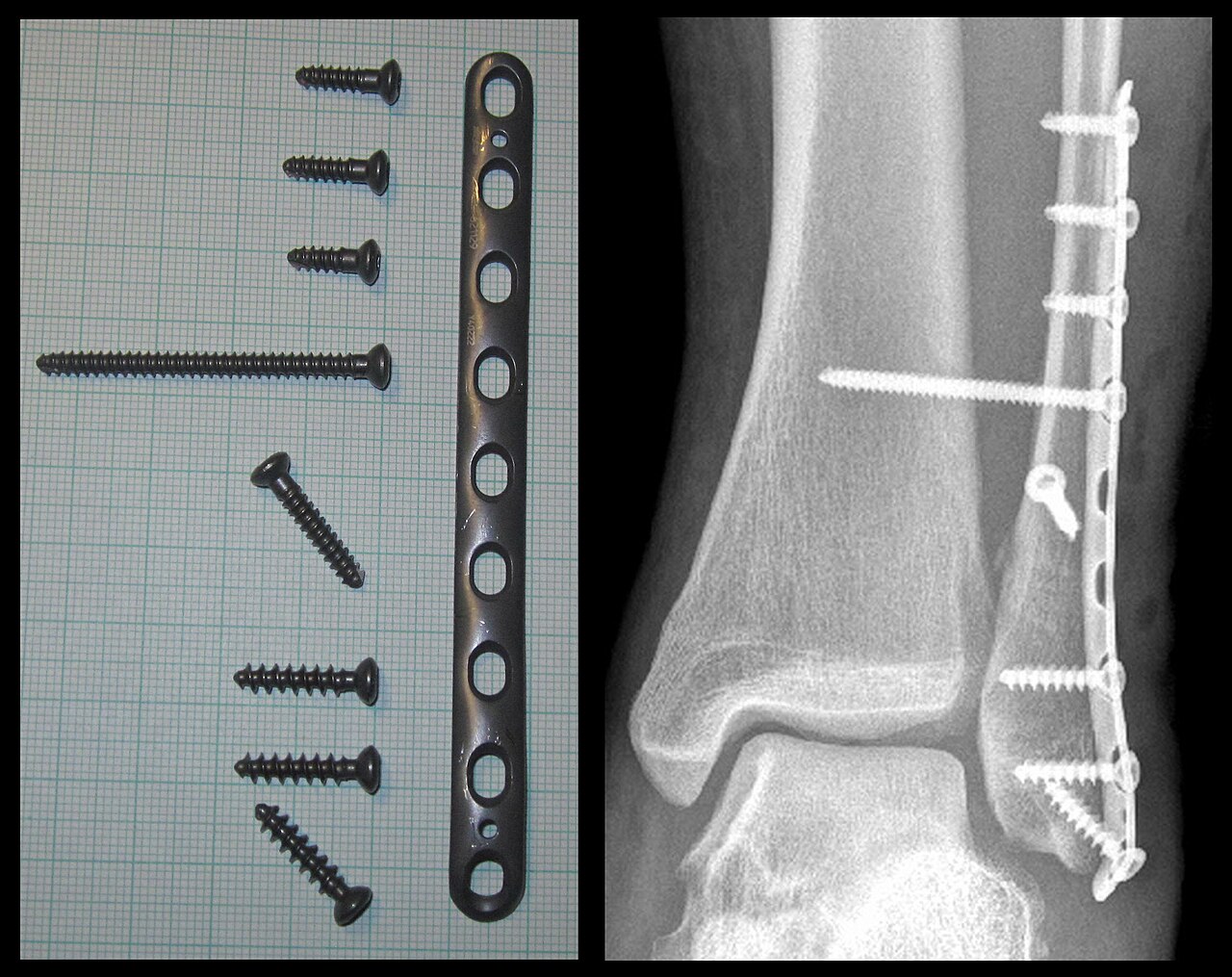 Ankle X-ray — Fracture