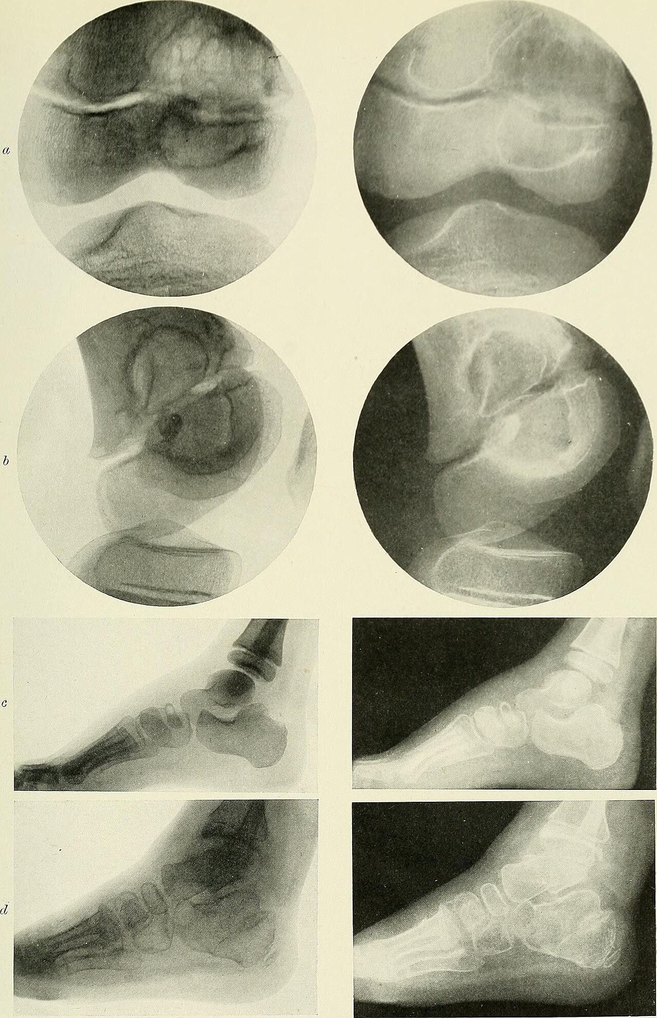 Ankle X-ray — Lateral
