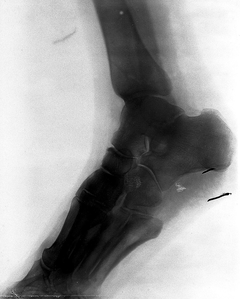 Foot X-ray — AP View