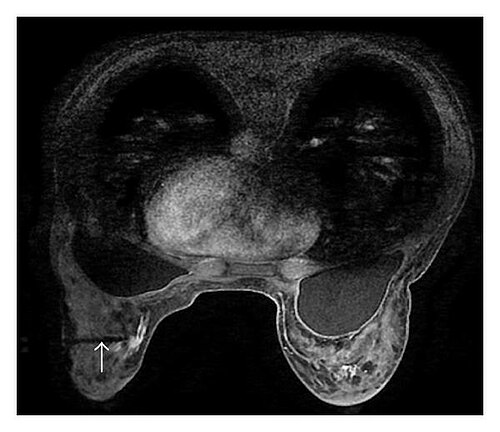 Breast MRI — Enhanced