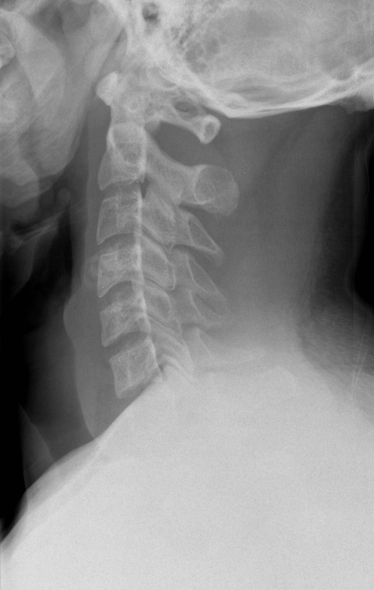 C-Spine X-ray — Lateral