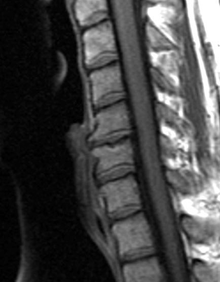 C-Spine MRI — Sagittal