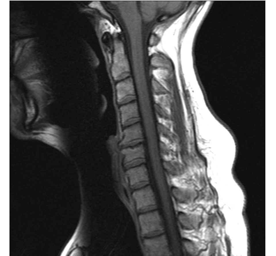 C-Spine MRI — Sagittal