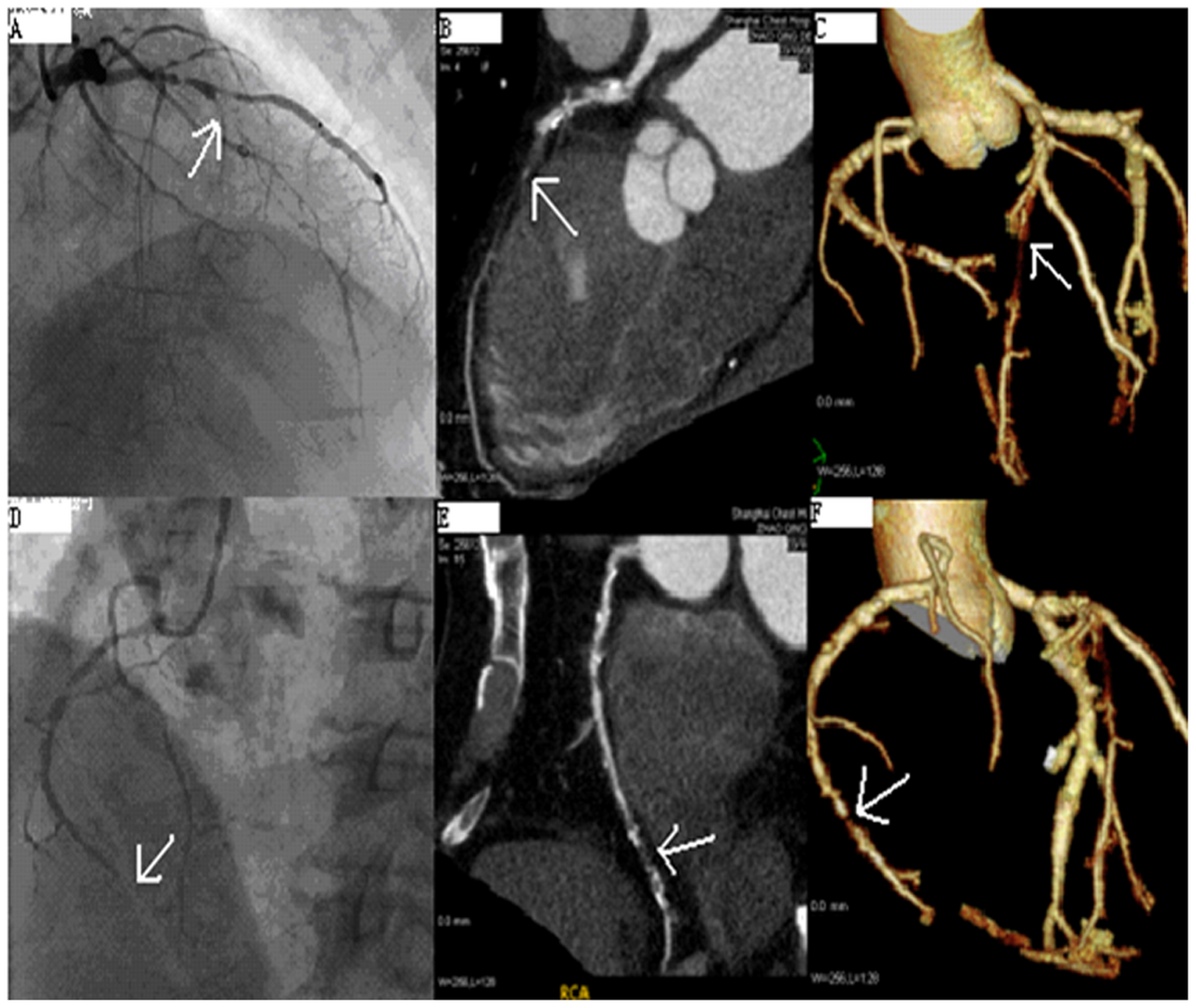 Cardiac CT — CTA