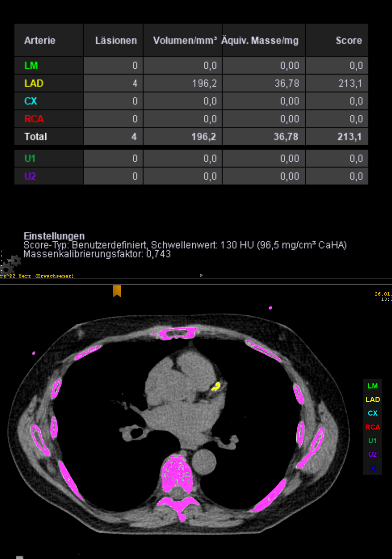 CCTA — Agatston Calcium Score