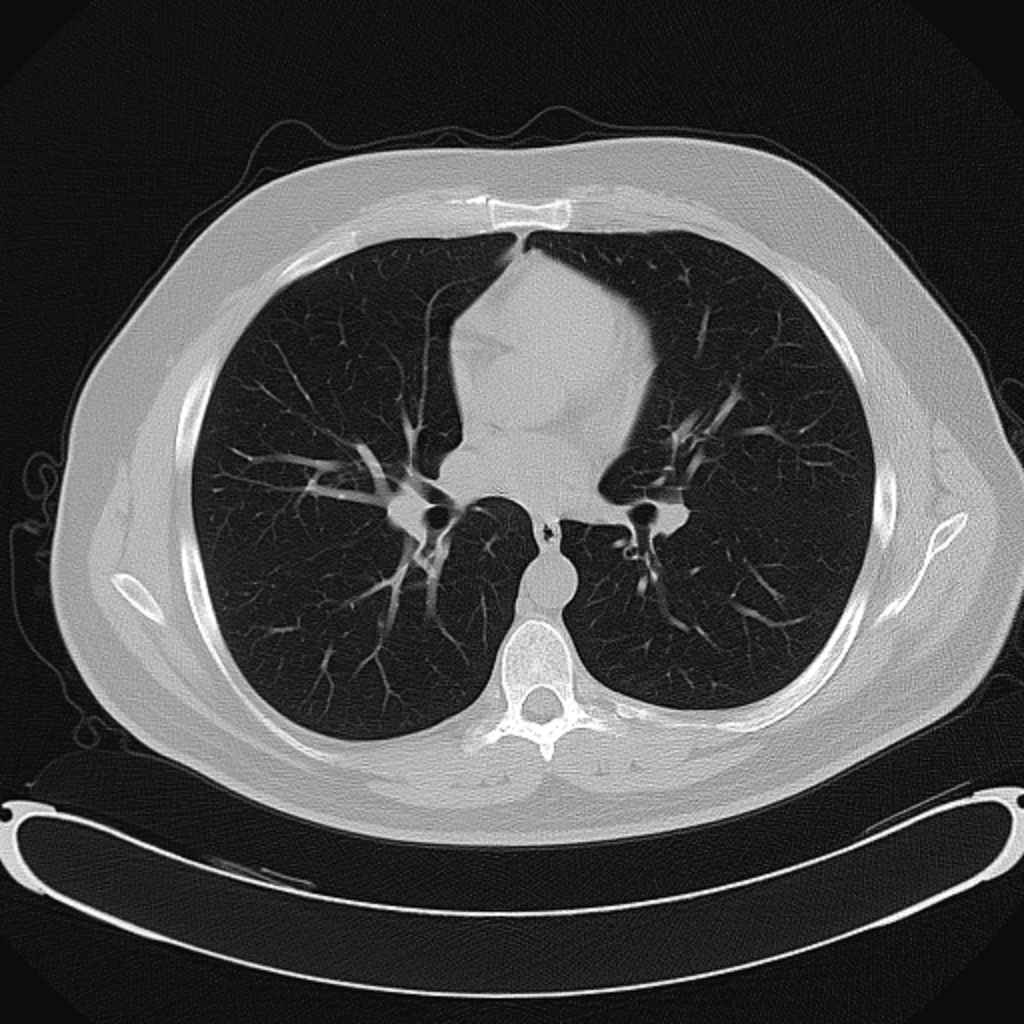 CT Thorax — Lung Window (B70f)