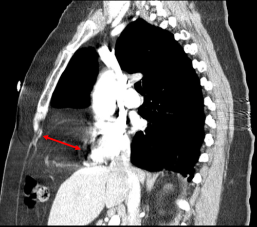 CT Thorax — Morgagni Hernia (Sagittal)