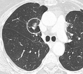 CT — Part-Solid Lung Nodule