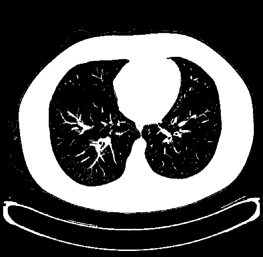CT Thorax — Lung Window (-700 HU)
