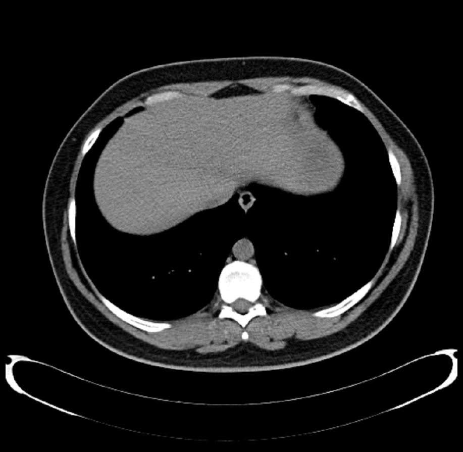 CT Thorax — Lower Chest / Upper Abdomen