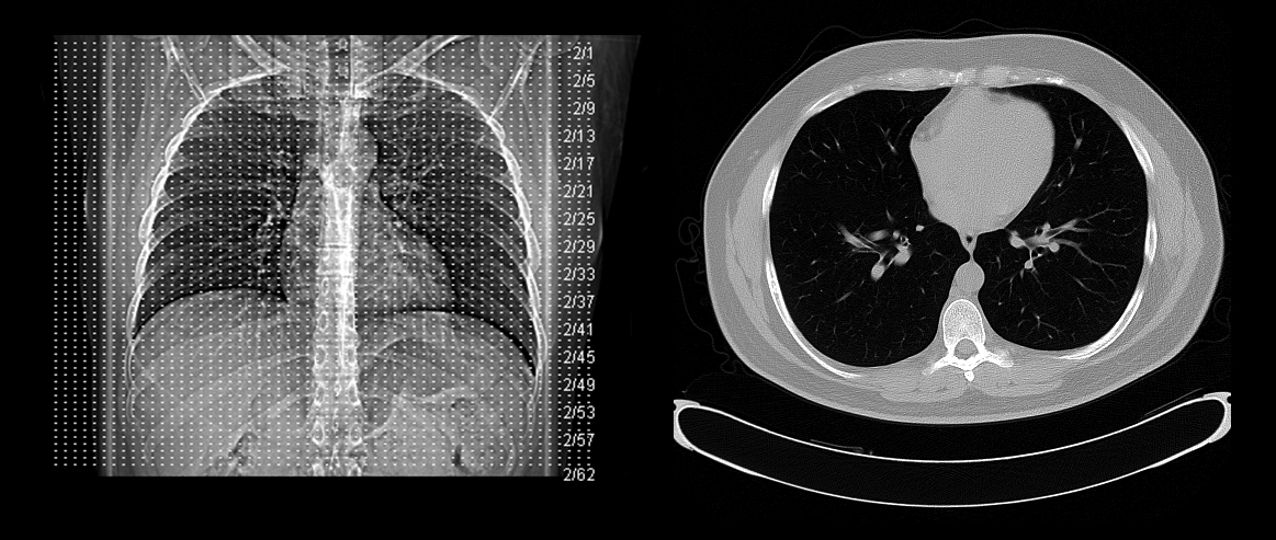 CT Thorax — Axial Illustrative