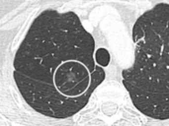 CT — Ground Glass Lung Nodule