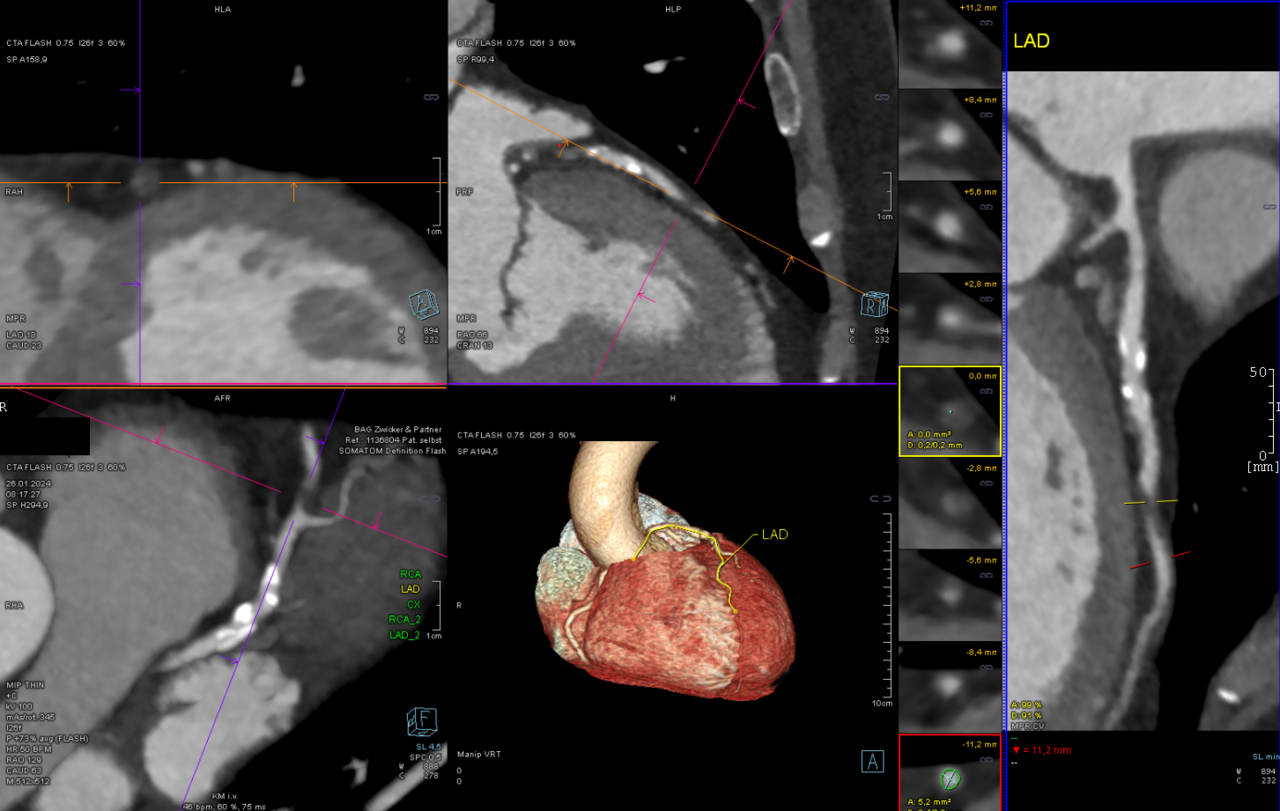 CCTA — CAD-RADS 4a Stenosis
