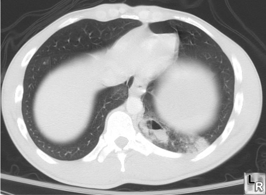 CT — Pulmonary Contusion