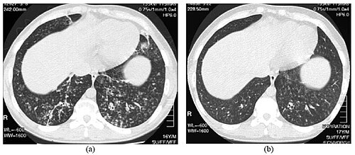 HRCT — Diffuse Panbronchiolitis