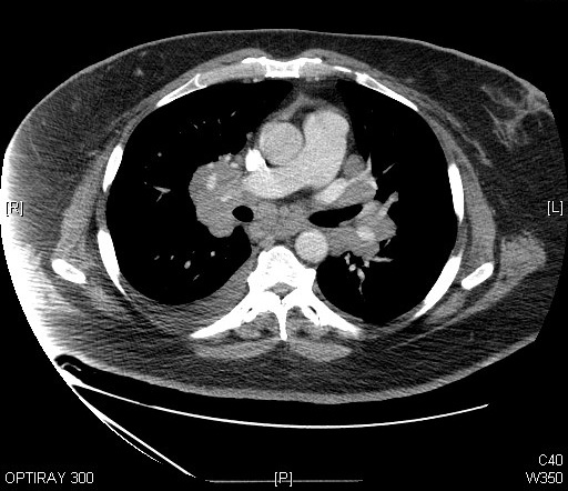 CT — Sarcoidosis (Bilateral Hilar Lymphadenopathy)