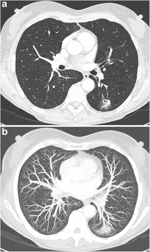 CT — Lung Nodule with Vascular Convergence
