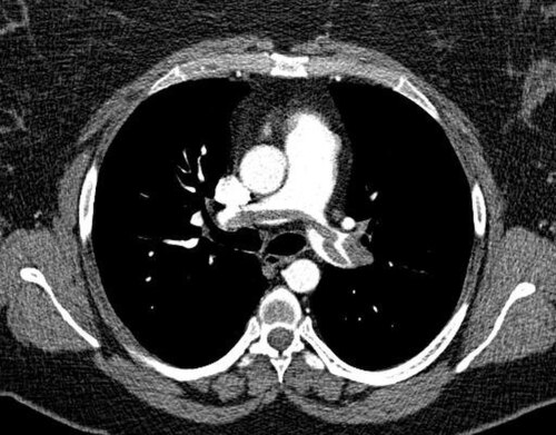 CT Angiography — Massive Pulmonary Embolism