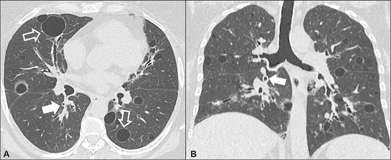 CT — Lymphocytic Interstitial Pneumonia