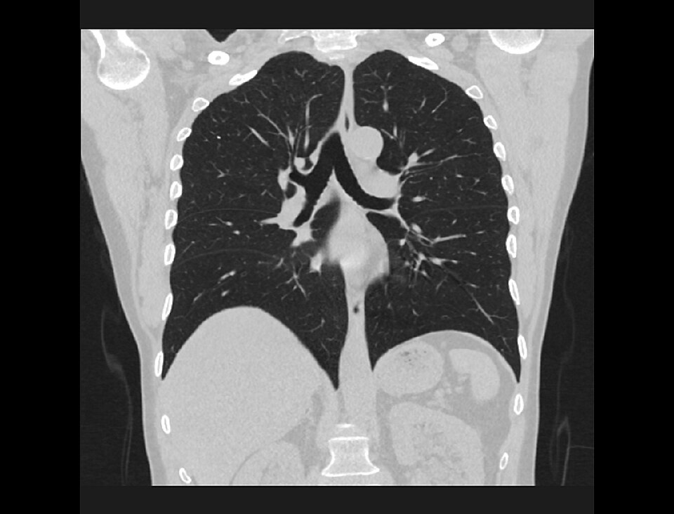CT Thorax — Coronal Lung Window