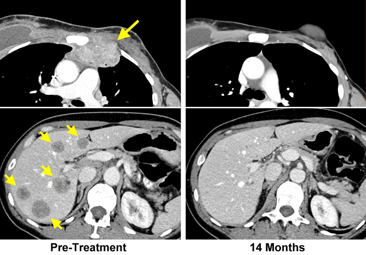 MRI — Chest/Cancer Staging