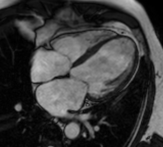 Cardiac MRI — 4-Chamber Cine (Infarct)