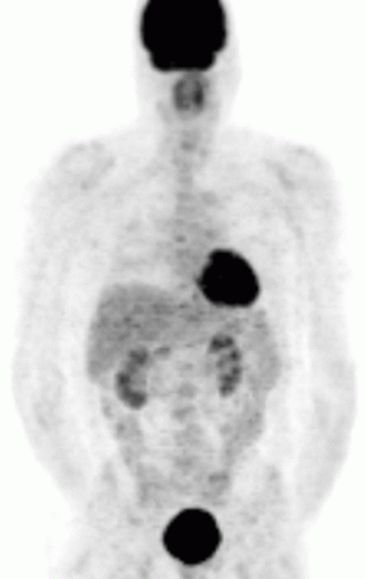 PET Scan — Axial Slice 3