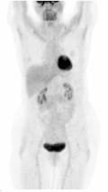 PET Scan — Axial Slice 1
