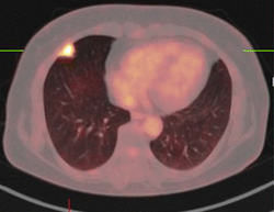 PET/CT — Pulmonary Tuberculoma