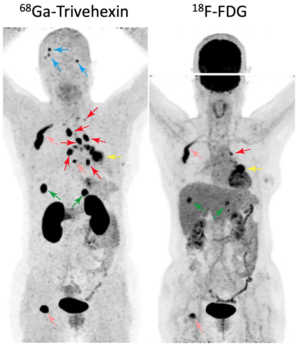 PET — NSCLC Ga-68 vs FDG Comparison