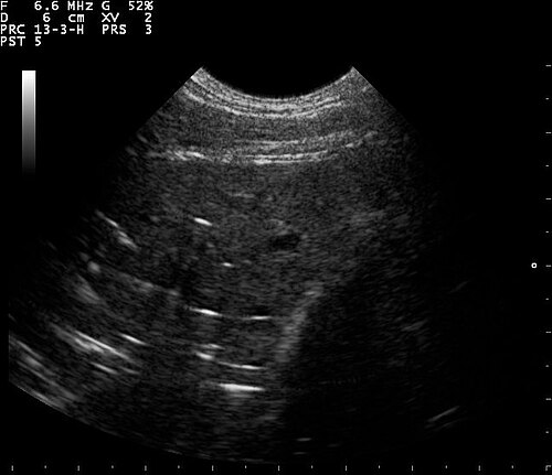 Lung Ultrasound — Wet Lung (Pulmonary Edema)