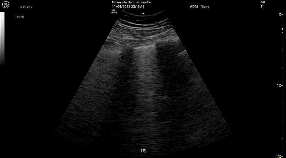 Lung Ultrasound — B-Lines (Pulmonary Fibrosis)