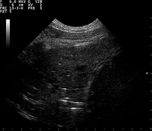 Lung Ultrasound — Wet Lung View 5