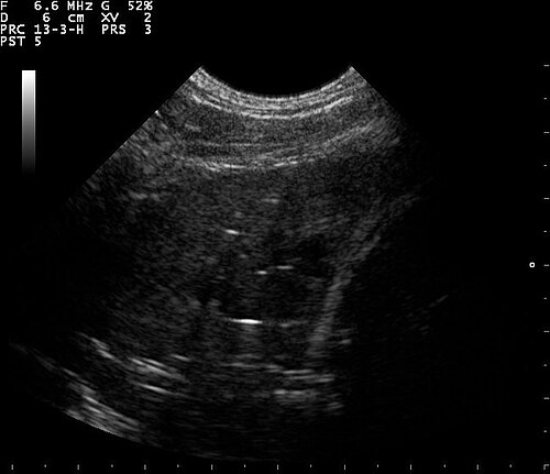 Lung Ultrasound — Wet Lung View 2