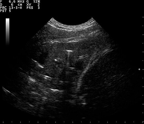 Lung Ultrasound — Wet Lung View 4