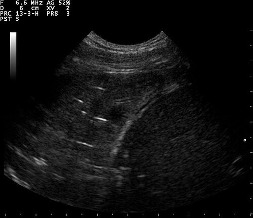 Lung Ultrasound — Wet Lung View 3