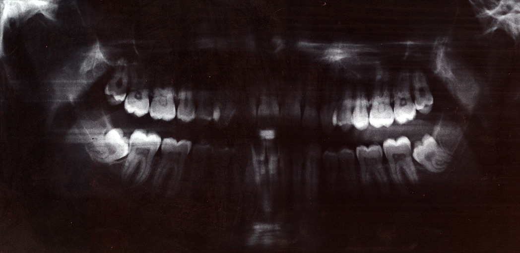 Panoramic (OPG) — Full Mandible
