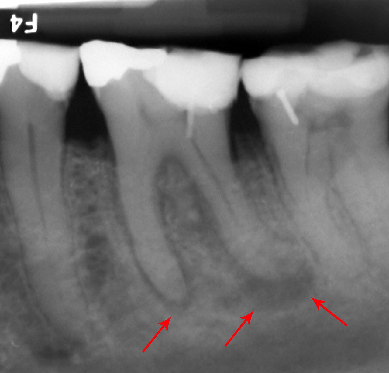Dental X-ray — Abscess