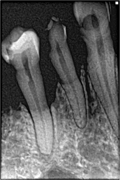 Dental X-ray — Periodontitis