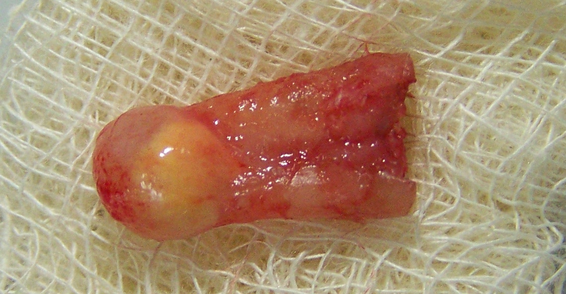 Dental X-ray — Periapical Abscess