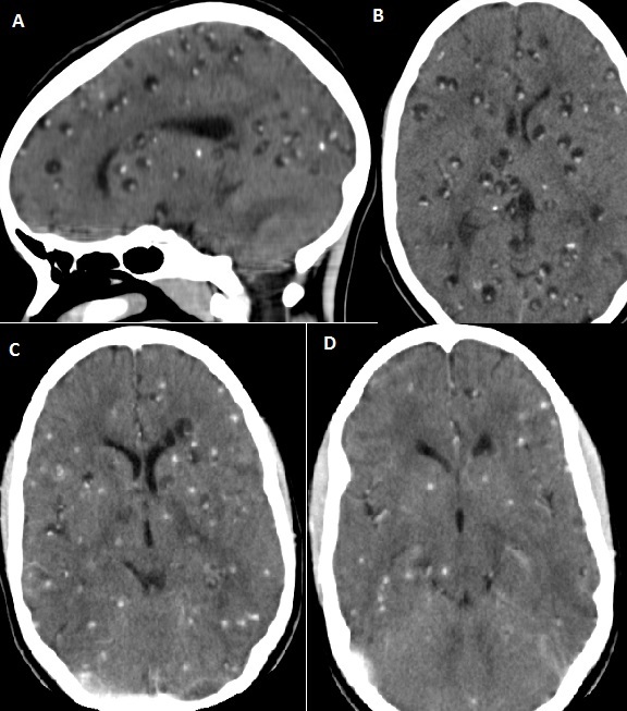 Head CT — Axial Brain