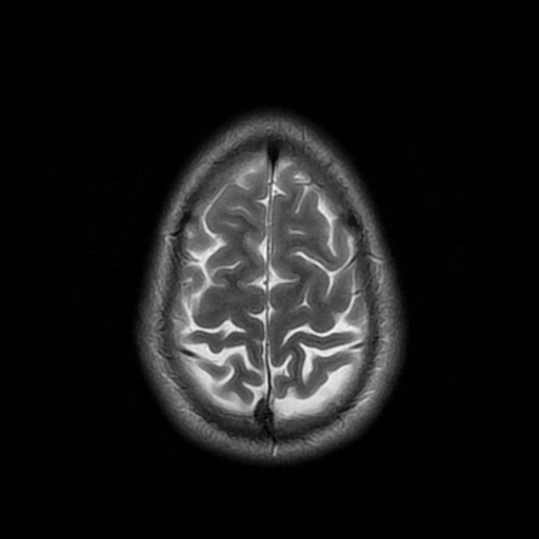 Brain MRI — Axial T2