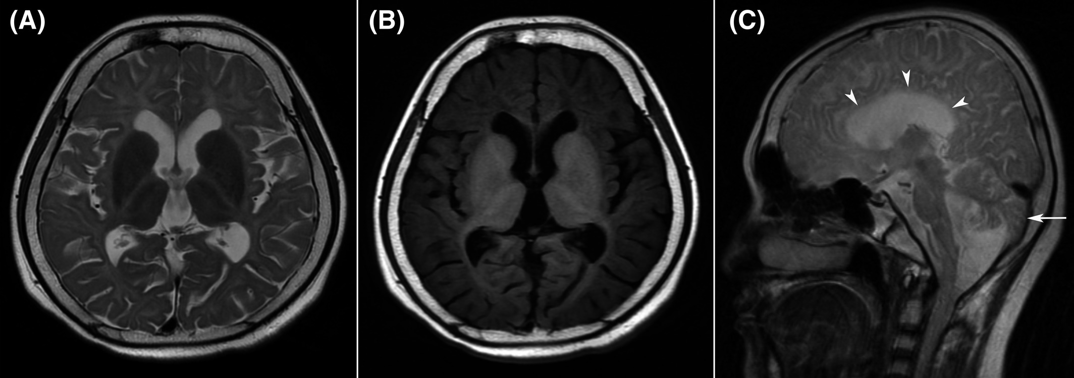 Brain MRI — Sagittal View