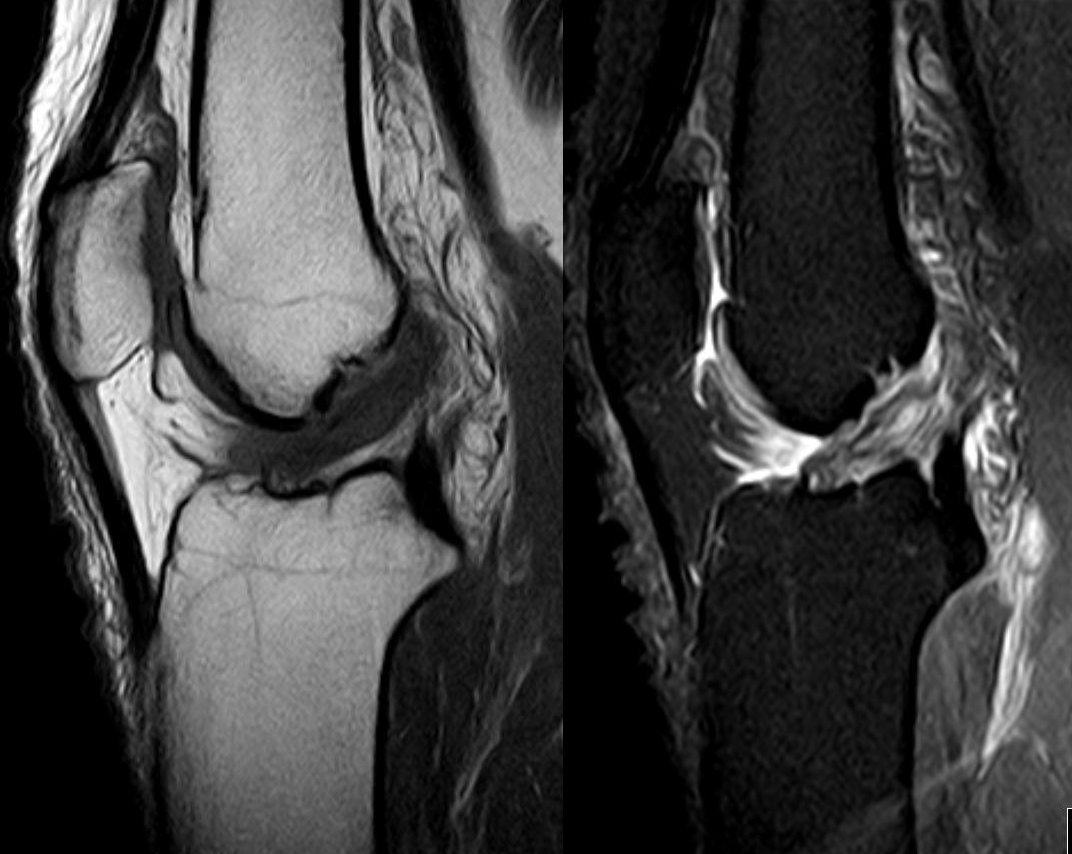 MRI — ACL Disruption