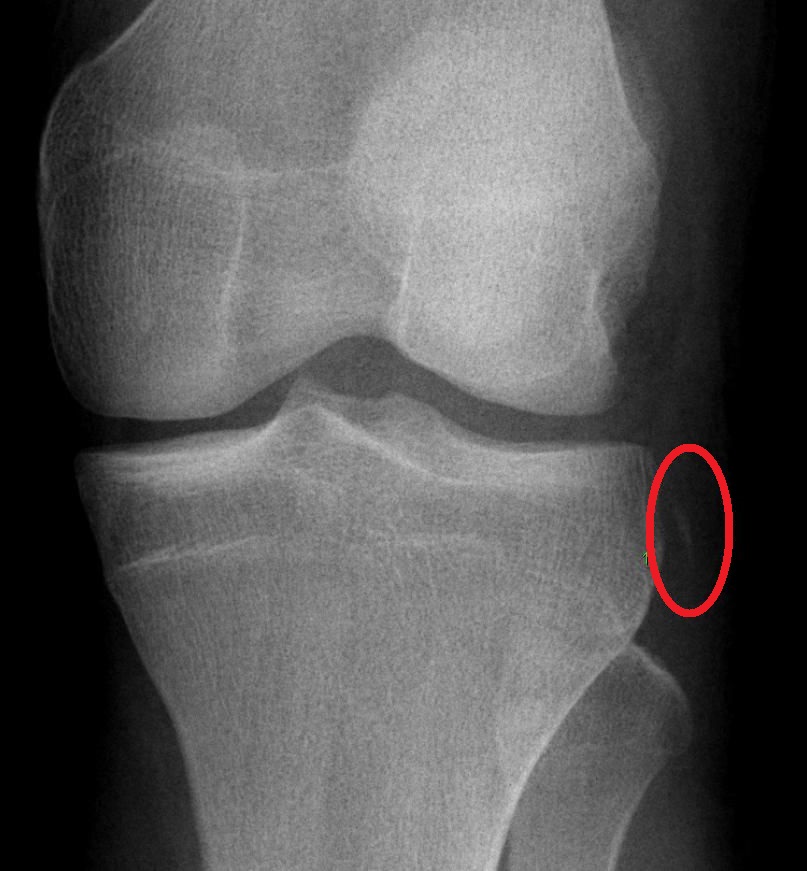 MRI — Knee Ligament Injury