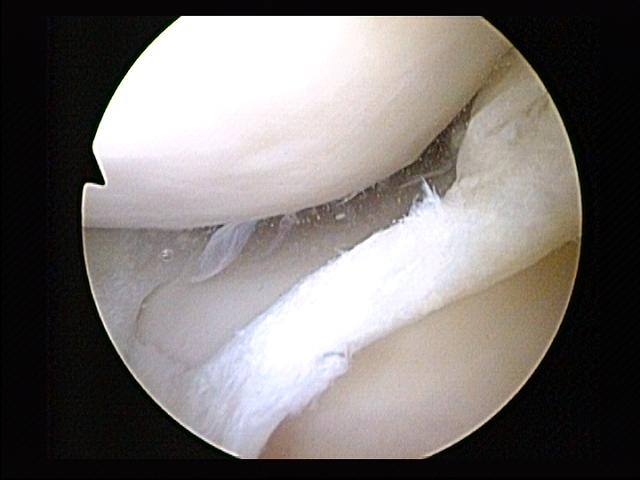 MRI — Medial Meniscus Tear