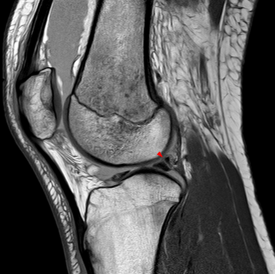 MRI — Meniscus Sagittal